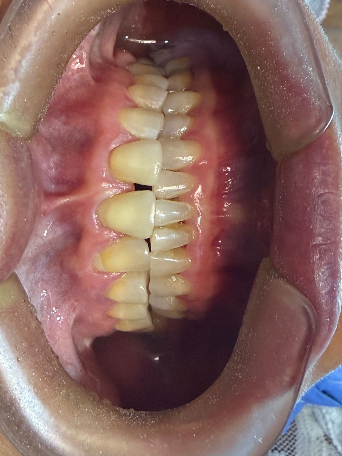 Antes del tratamiento dental en Orthodent Ibagué