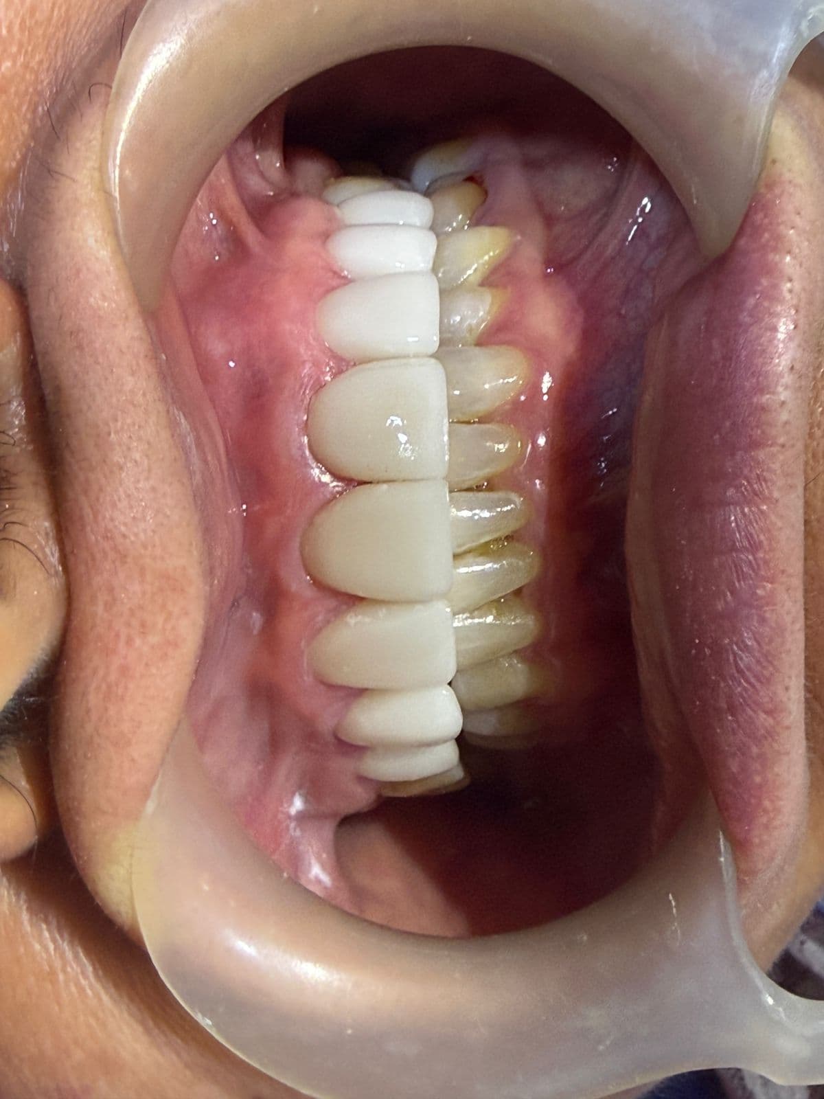 Resultado después del tratamiento dental en Orthodent Ibagué