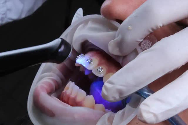 Tratamiento de ortodoncia con brackets en Orthodent Ibagué