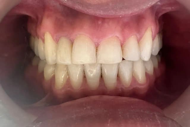 Limpieza dental profesional en Orthodent Ibagué